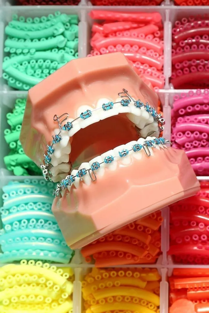 Modelo dental con brackets de ortodoncia