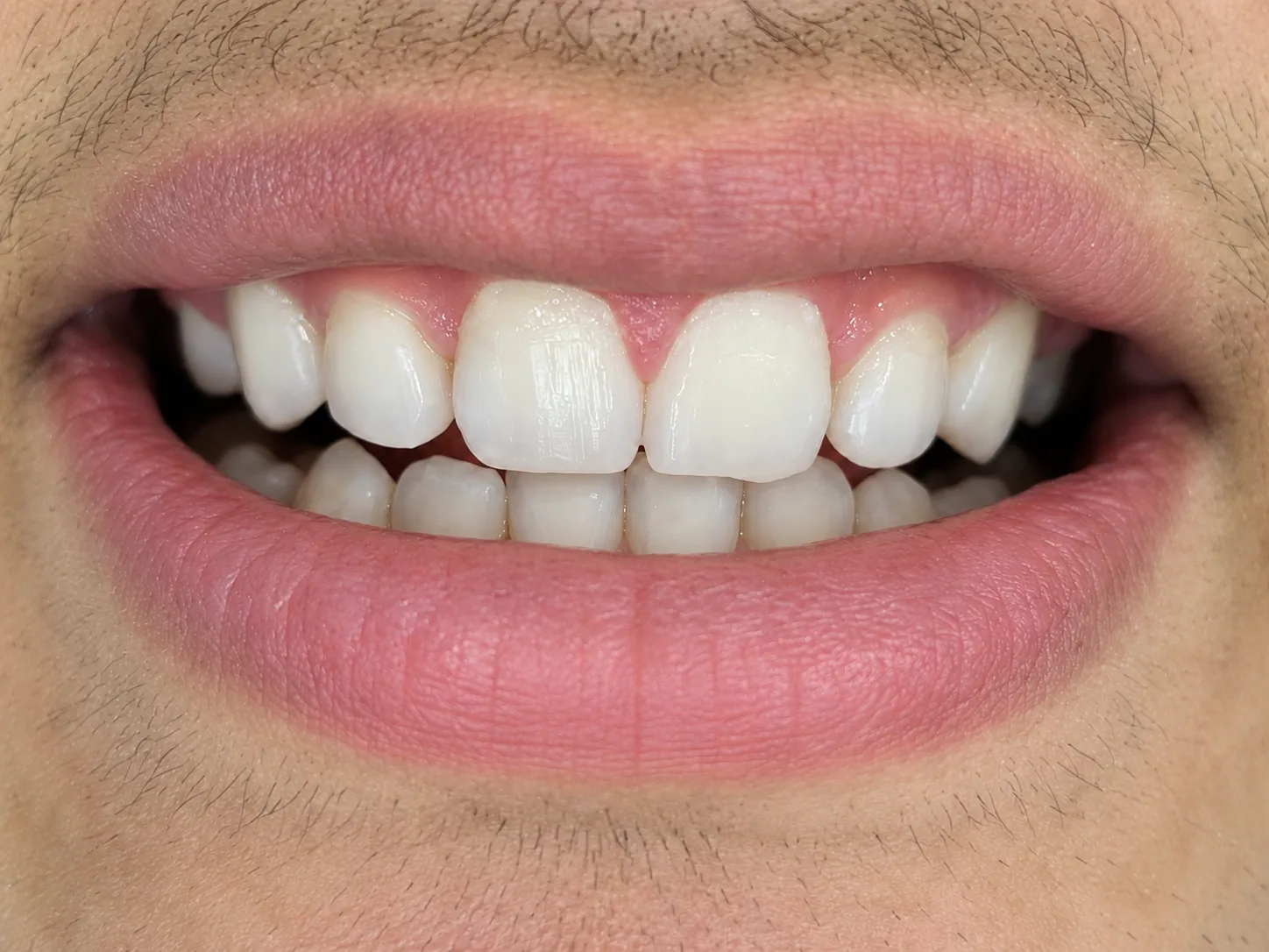 Sonrisa después del tratamiento de estética dental en Panamericana Odontólogos